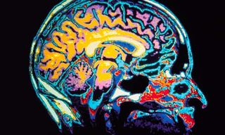 MRI-of-the-brain-006